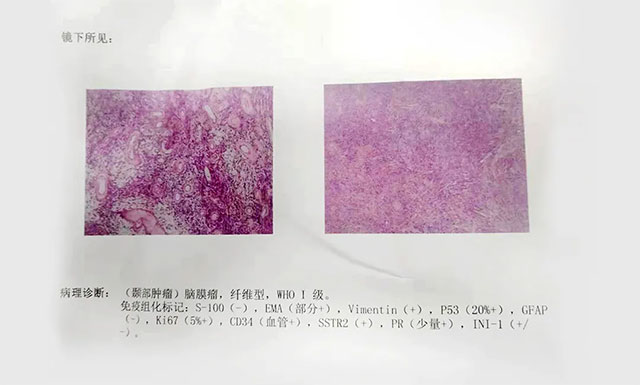 “元兇”為腦膜瘤